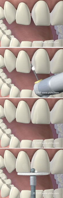 Tooth Bonding Illustration