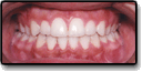 A case example of corrected teeth after fixing a crossbite