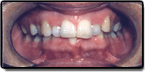 A second case example of a mouth with teeth alignment problems from crowded teeth