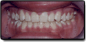 A case example of a mouth after correcting an overbite