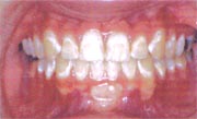 A case example of improperly cleaned teeth after braces have been removed