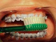 A person with braces having the bottom of their front teeth brushed