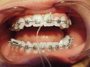 A person with braces having their teeth flossed carefully around the braces