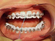 A person with braces having their teeth flossed carefully around the gum area