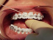 A person with braces having each tooth flossed