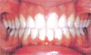A case example of properly cleaned teeth after braces have been removed