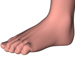 A 3D digital model of a foot with hammertoe of the little toe