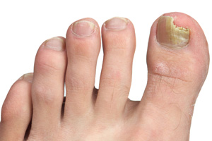 Photo: A foot showing the toes with the big toe chipped and discolored