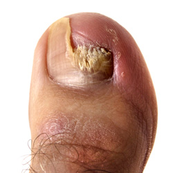 Photo: A close up of the big toe with the nail broken and discolored