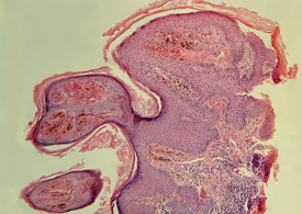 An example of an HPV cell that causes warts