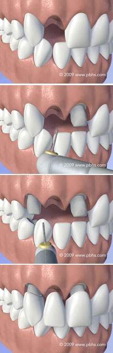 Tooth Bridge Illustration