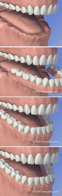 Dentures Illustration