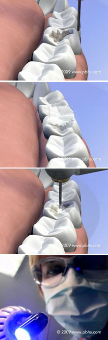 Tooth Inlays Illustration