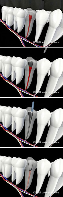 Root Canal Illustration
