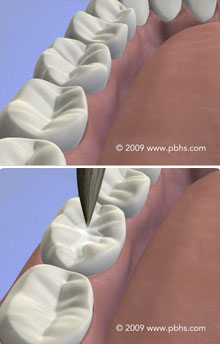 Tooth Sealants Illustration