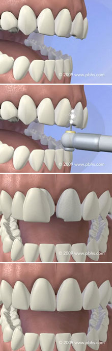 Tooth Veneers Illustration