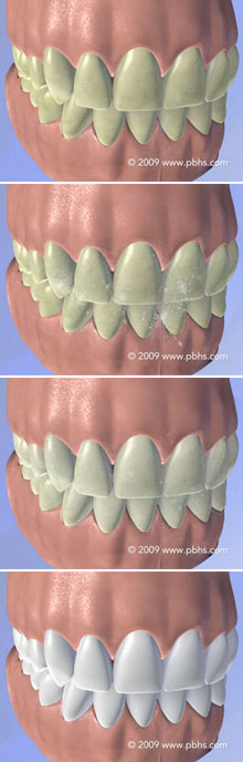 Tooth Bleaching Illustration