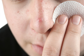 A youth with acne using a cotton pad to clean his face
