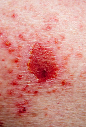 Close up image of basal cell carcinoma