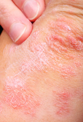 Skin with eczema