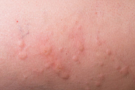 Skin with hives