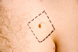 Photo: A mole marked for possible melanoma on a male's chest