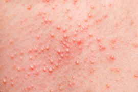 Skin with a hives rash