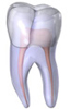 Digital illustration: cracked tooth cusp