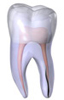 A 3D model of a tooth with a vertical root fracture