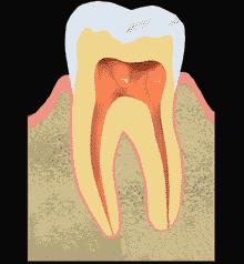 illustrated animation showing tooth before, during, and after root canal