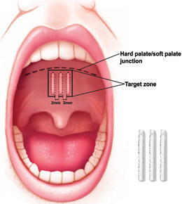 An illustration showing where the pillar procedure is performed in the mouth