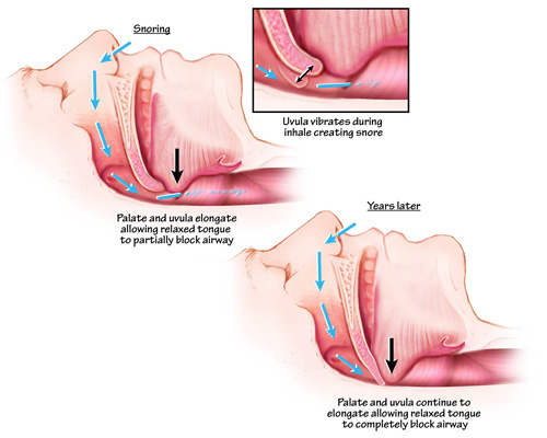A diagram showing how the uvula vibrates during inhales causing snoring