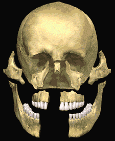 Ilustración animada de un cráneo con trauma facial