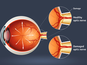 Diagram of Damaged Eye
