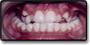Patient's mouth with a crossbite