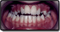 A second case example showing misaligned teeth caused by a crossbite