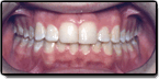 A case example of a mouth after correcting problems caused by teeth crowding
