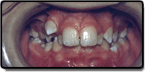 Crowding and Spacing Teeth - Before Treatment