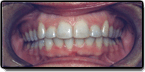 A second case example of a mouth after correcting problems caused by teeth crowding