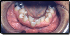Patient's mouth with overcrowded bottom teeth before orthodontic correction