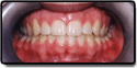A case sample of a corrected impacted tooth