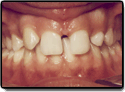 Patient's mouth with missing teeth before orthodontic correction