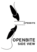 A side view diagram showing the position of the mouth and teeth with an openbite