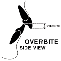 A side view illustration showing what an overbite looks like