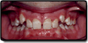 Patient's mouth with an overbite before orthodontic correciton
