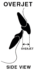 A side view diagram showing what the position of the teeth are with an overjet