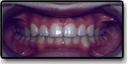 Mouth after correcting problems caused by overly spaced teeth