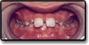 A case example of a mouth with teeth alignment problems from exaggerated teeth spacing