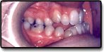 Side view of a patient's mouth with an underbite before orthodontic correction