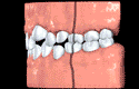 Animation of a class 1 bite with crowded teeth
